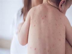 measles